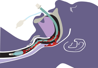 Analysis of remaining motion using one innovative upper airway opening cervical  collar and two traditional cervical collars