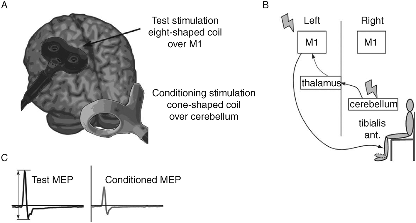 Functional electrical stimulation in neurorehabilitation (Chapter 12) -  Textbook of Neural Repair and Rehabilitation