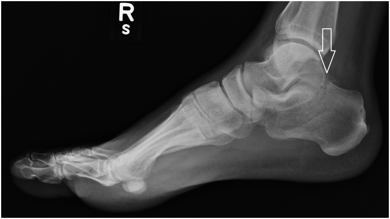 LearningRadiology - Calcaneal, calcaneous, Stress, Fracture