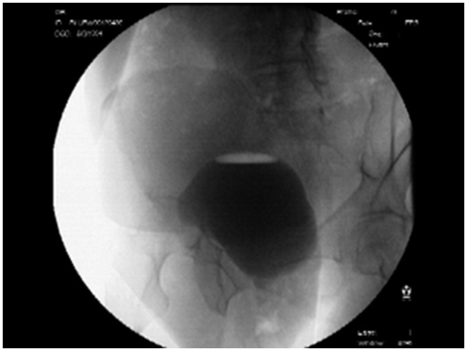 Image: Chest X-Ray of a Patient with Fluid in Minor and Major Fissures -  Merck Manuals Professional Edition