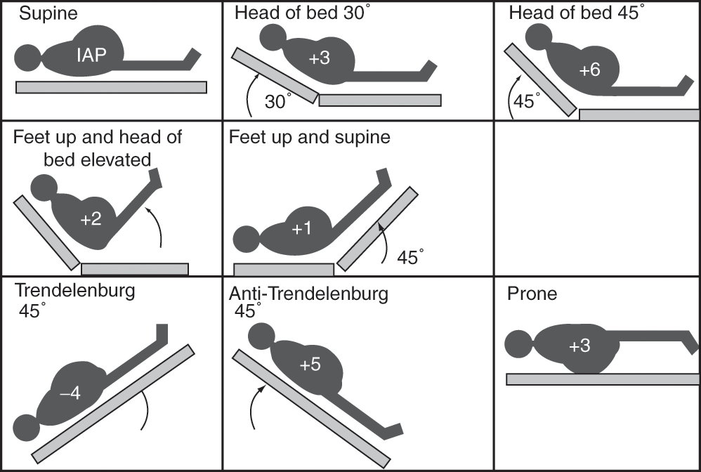 Summary of effects of different body positions on IAP compared to the