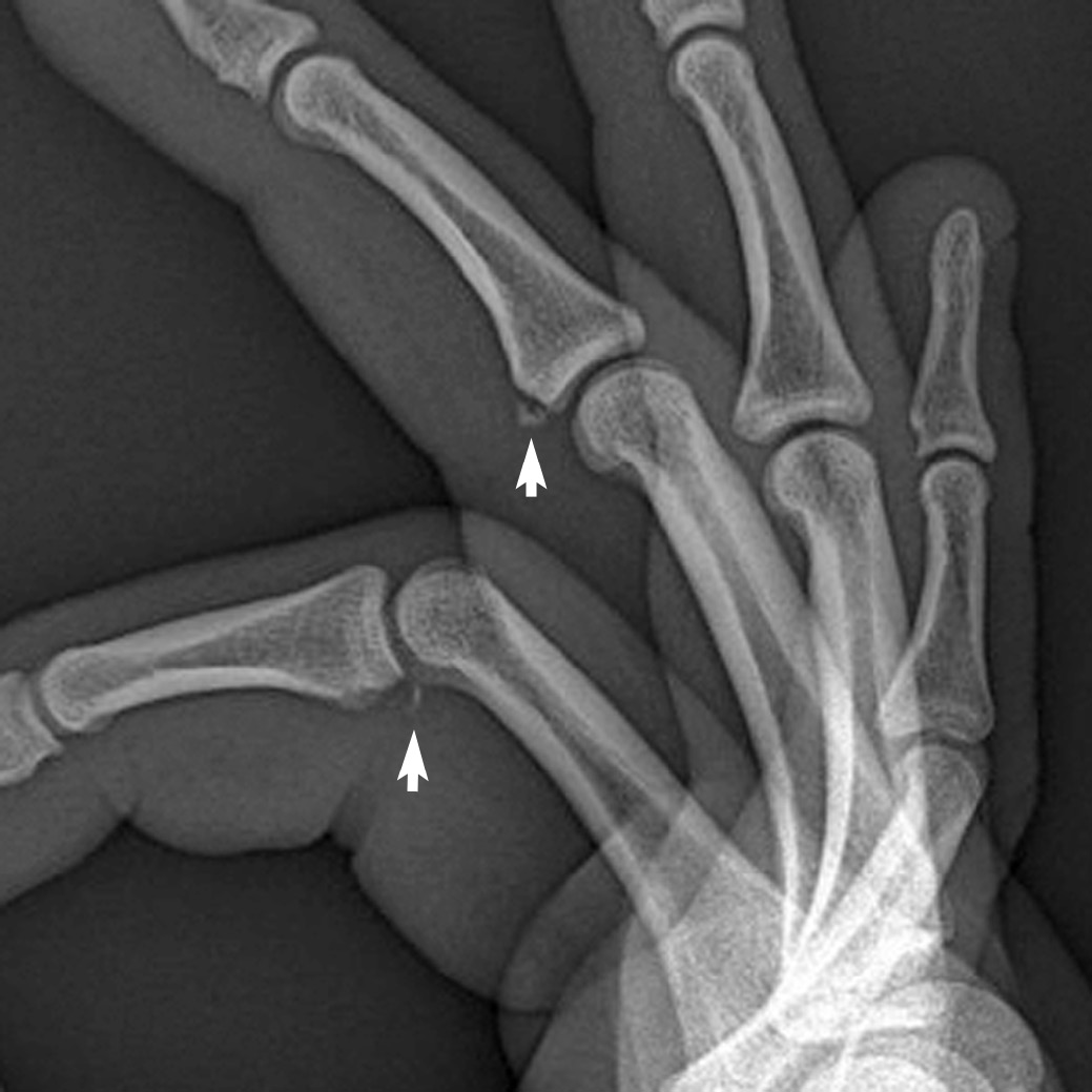 avulsion fracture finger