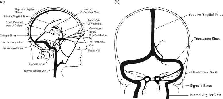 Cerebral Venous Thrombosis And Intracerebral Hemorrhage Chapter 7 Intracerebral Hemorrhage