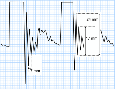 Mechanical PQ intervals (in milliseconds) according to fetal heart rate