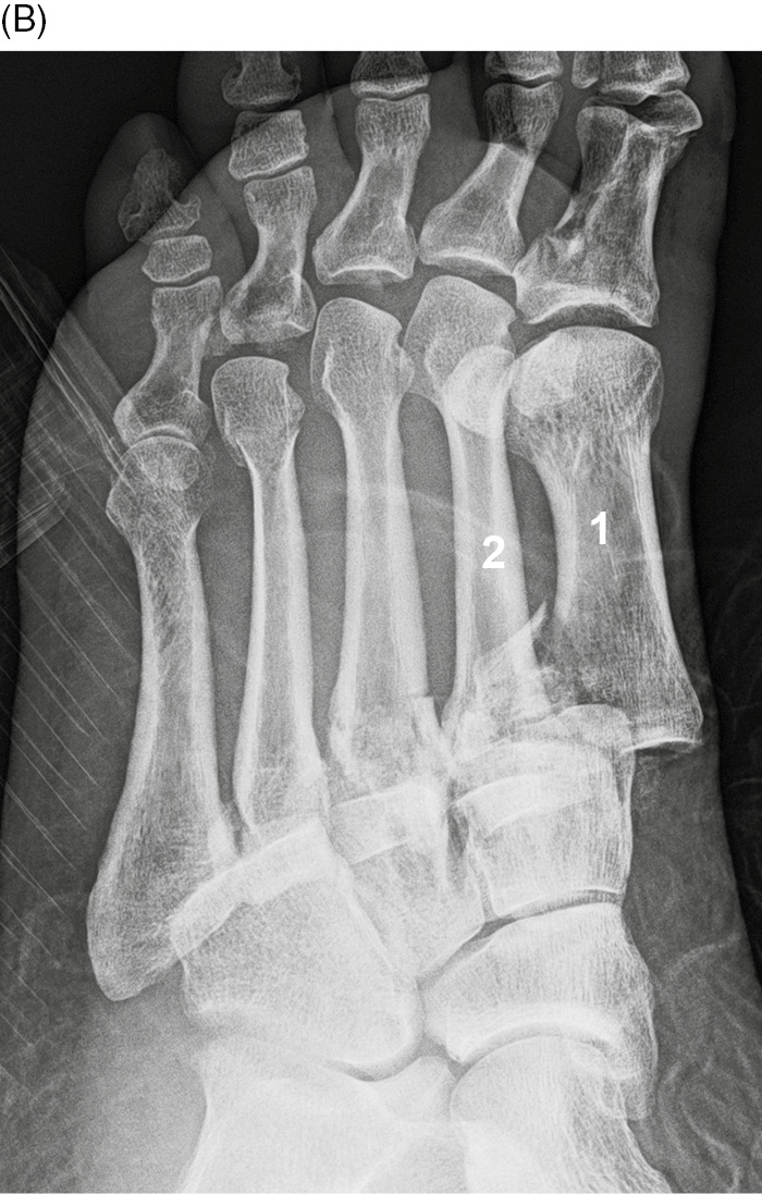 Fractures and dislocations of the metatarsals and toes (Chapter 14 