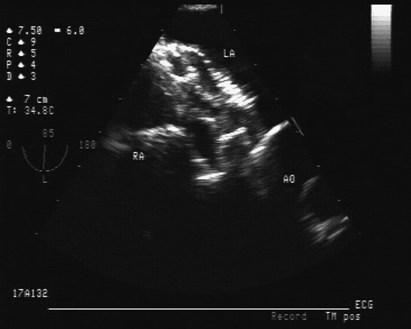 Adult congenital heart disease (Chapter 20) - Core Topics in  Transesophageal Echocardiography