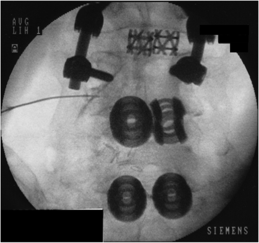 The diagnostic pitfalls of lumbar disc herniation---- malignant sciatic  nerve tumour: two case reports and literature review, BMC Musculoskeletal  Disorders