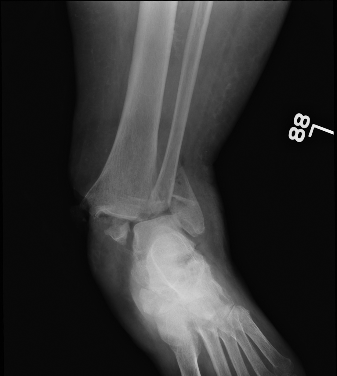 Foot and ankle emergencies (Chapter 5) - Orthopedic Emergencies