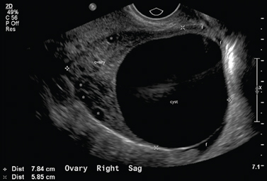 Pelvic Ultrasound Chapter 7 Atlas Of Emergency Ultrasound