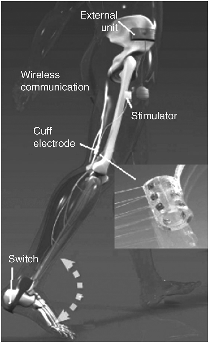 Functional electrical stimulation in neurorehabilitation (Chapter 12) -  Textbook of Neural Repair and Rehabilitation