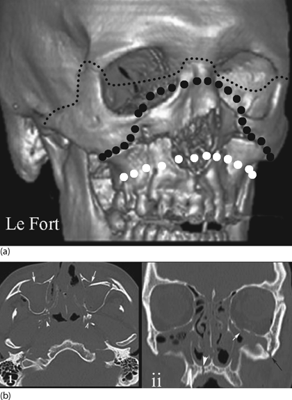 le fort fracture x ray