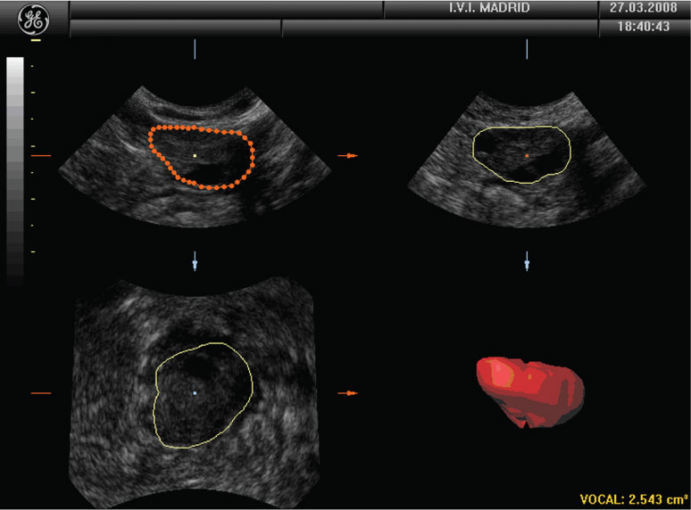 Ultrasonography in infertility (Section 2:) - Ultrasonography in  Reproductive Medicine and Infertility