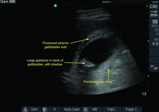 Christopher Kumetz on X: Wall Echo Shadow (WES) Sign! - Can be confused  with bowel - Gallbladder full of stones! - High risk for evolving into  acute cholecystitis - Tx: Surgery consult