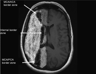 Anoxic Brain Injury Ct