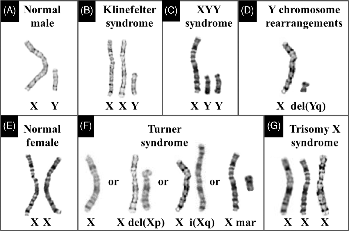 turner syndrome male karyotype