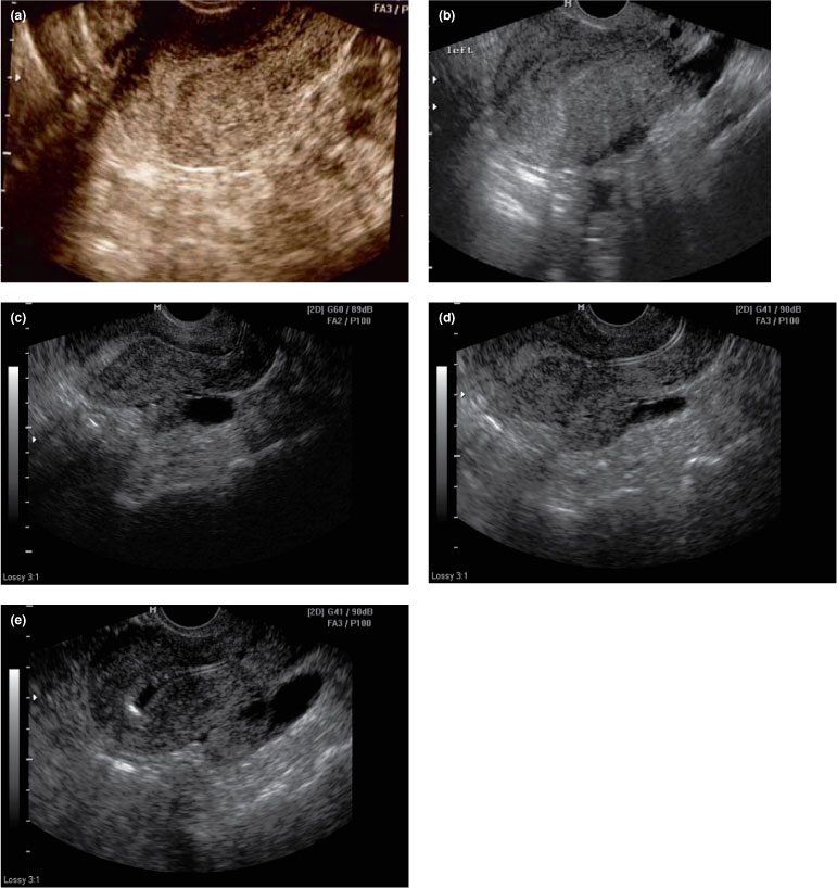 Sonographic findings in acute urinary retention secondary to retroverted  gravid uterus: pathophysiology and preventive measures - Yang - 2004 -  Ultrasound in Obstetrics & Gynecology - Wiley Online Library