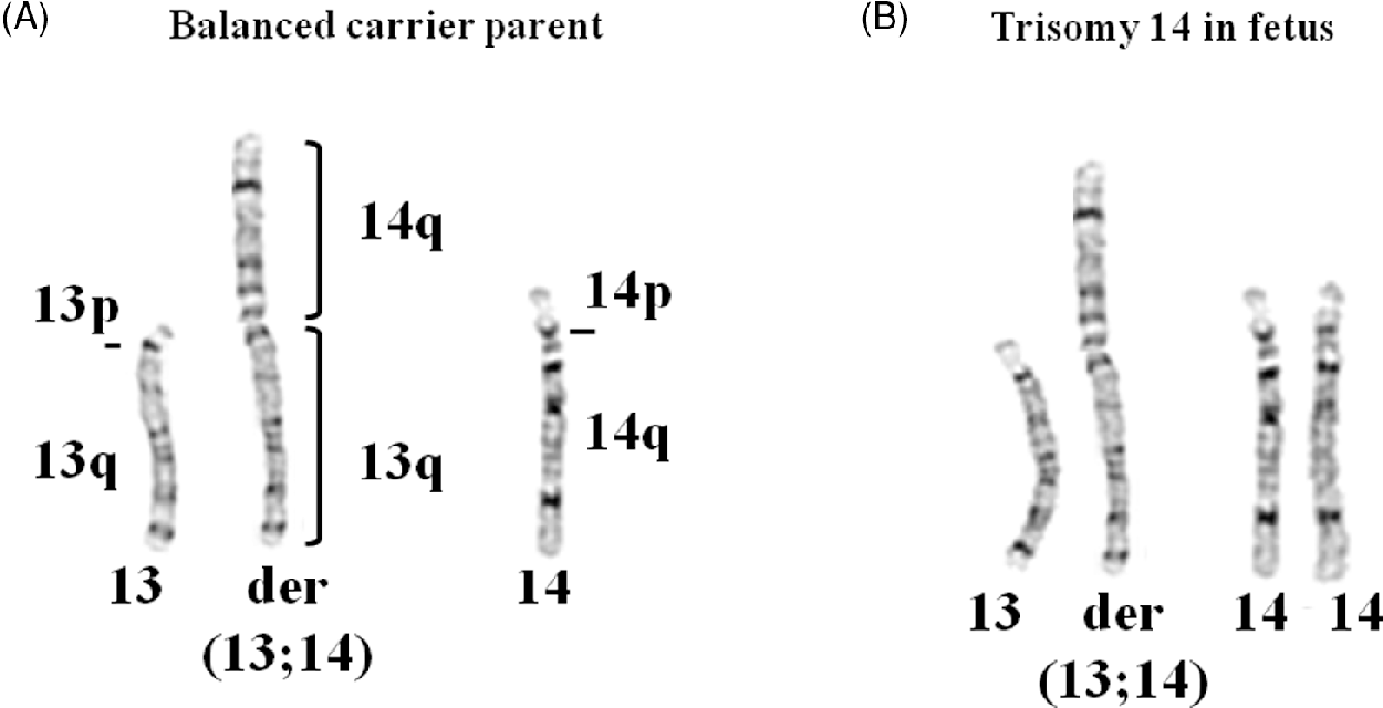 PDF] Ring Chromosome 13 in an Infant Girl | Semantic Scholar