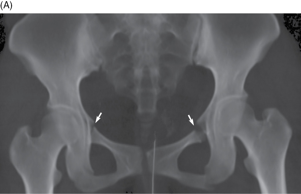 superior pubic ramus fracture