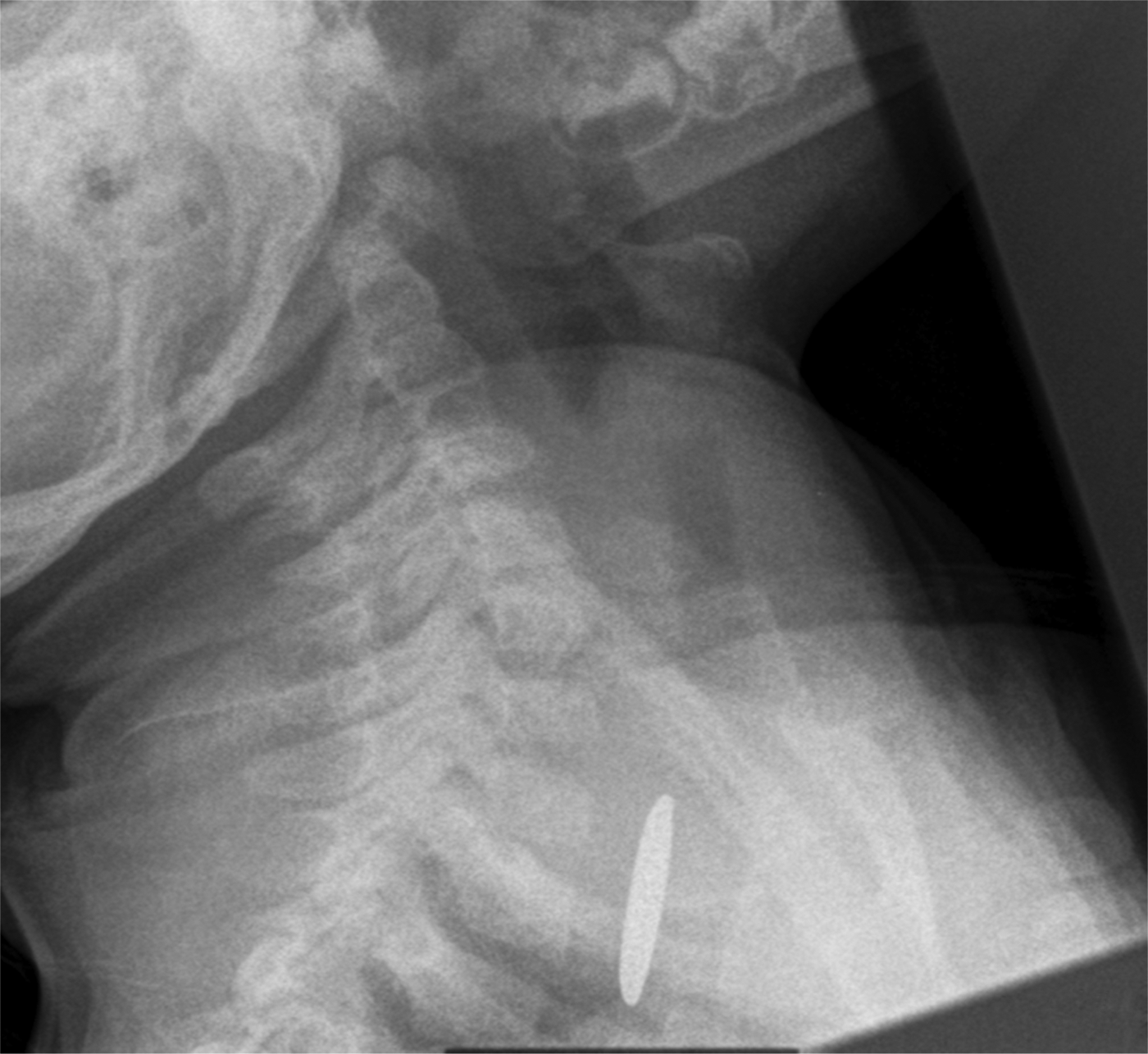 Accidental button battery ingestion presenting as croup The Journal