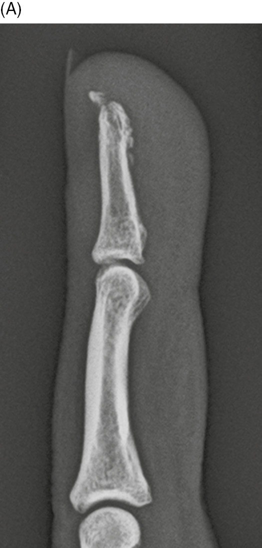 middle phalanx fracture