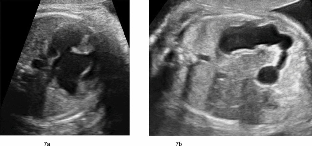 FIRST AND SECOND TRIMESTER SONOGRAPHIC SCREENING FOR FETAL DOWN ...