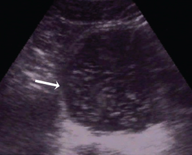 健康・医学 ATLAS OF Renal Ultrasonography O'NEILL Sonographic evaluation of renal failure - American Journal