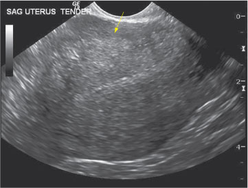 Adenomyosis Chapter 16 Ultrasonography In Reproductive Medicine And Infertility