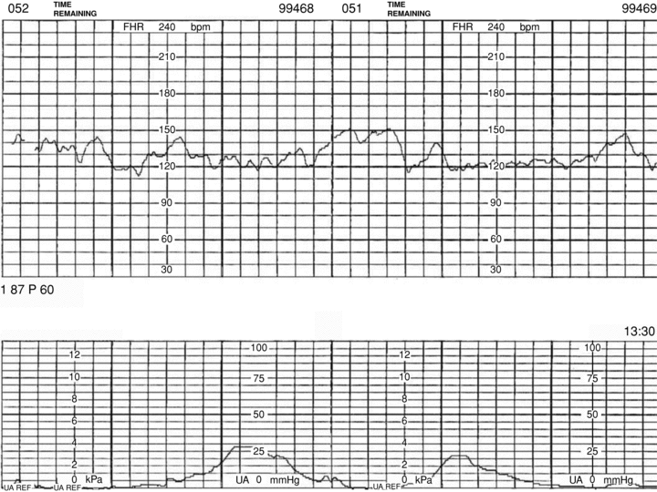 reactive fetal heart rate tracing