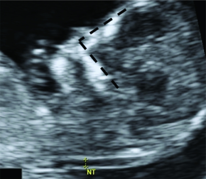 FIRST AND SECOND TRIMESTER SONOGRAPHIC SCREENING FOR FETAL DOWN ...