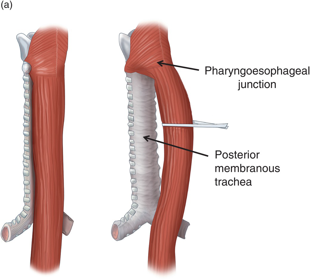 trachea