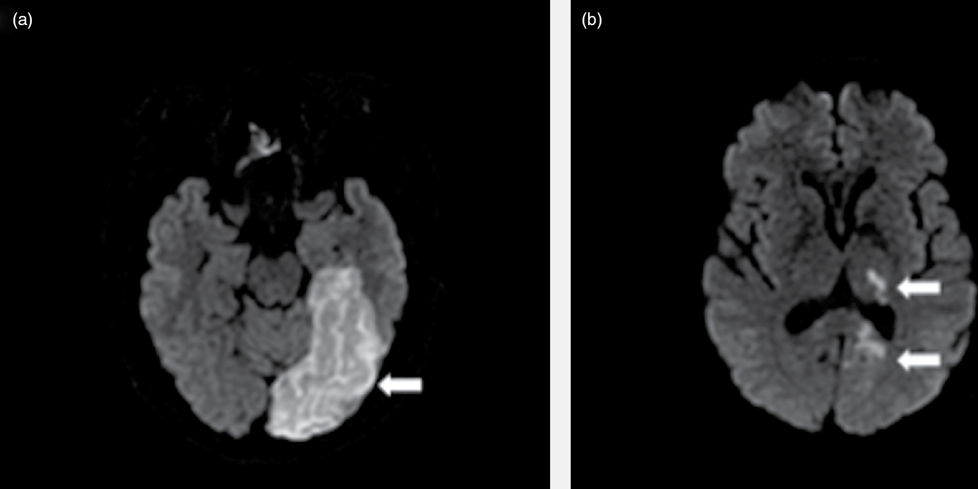 posterior cerebral artery distribution