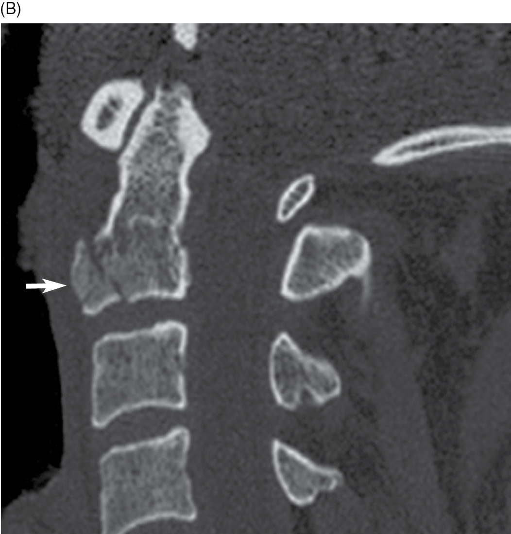 Posterior Temporary C1-2 Pedicle Screws Fixation for the Treatment of  Unstable C1-2 Complex Fractures: Minimum of 2-Year Follow-Up - Yakubu  Ibrahim, Hao Li, Geng Zhao, Suomao Yuan, Yiwei Zhao, Wubo Liu, Yonghao, image size:1052x1098