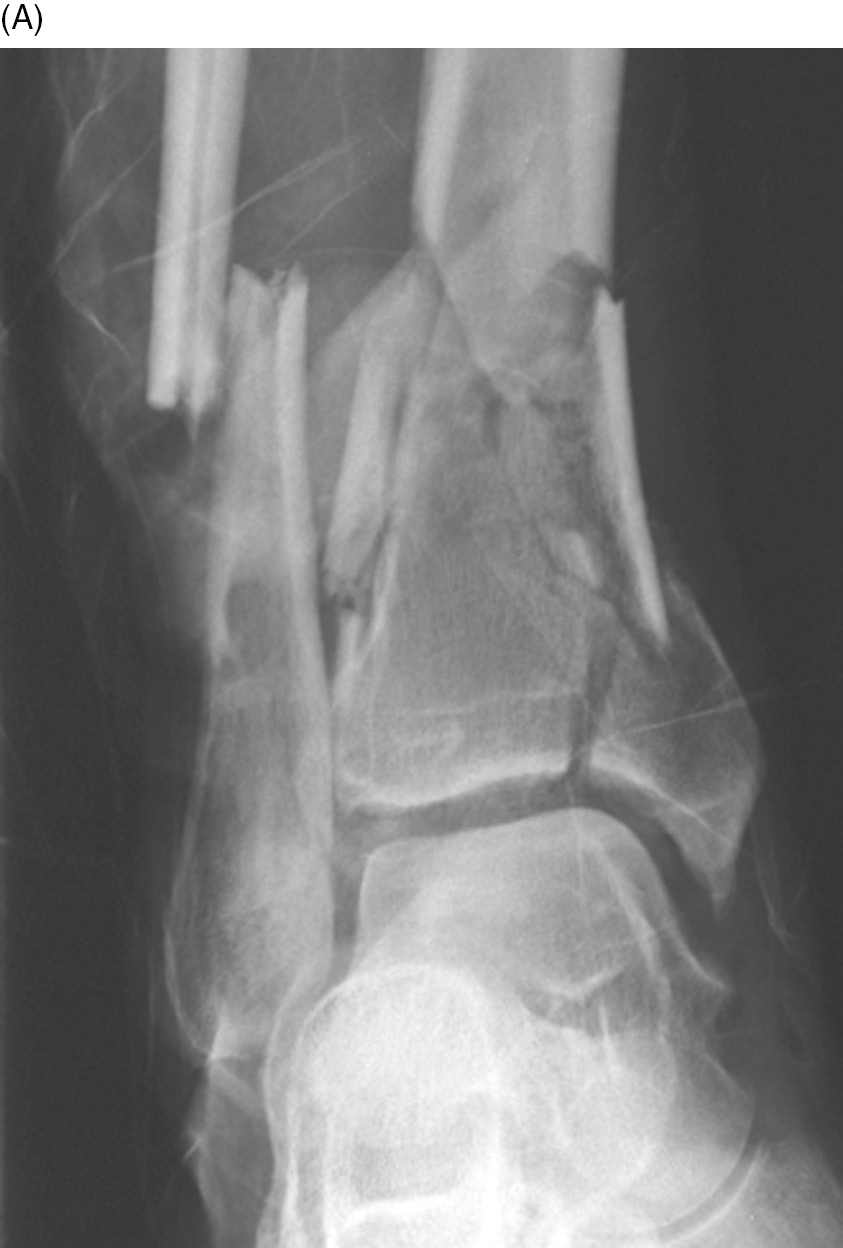 left trimalleolar ankle fractures dislocations