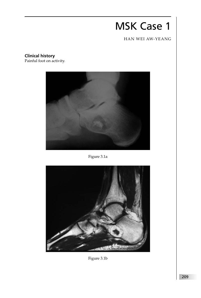 Iliotibial Band Friction Syndrome - MSK Radiology Imaging