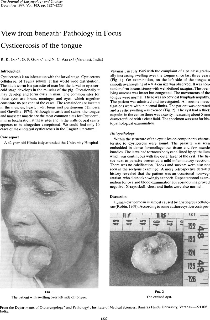 Cysticercosis of the tongue | The Journal of Laryngology & Otology ...