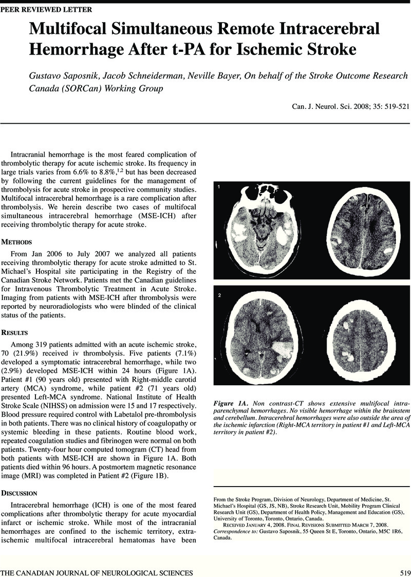 multifocal-simultaneous-remote-intracerebral-hemorrhage-after-t-pa-for