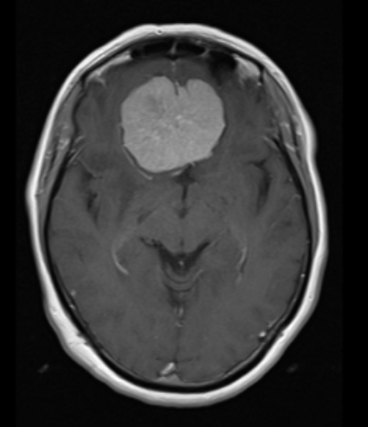 Neuropsychiatric symptoms as first manifestation of olfactory groove ...