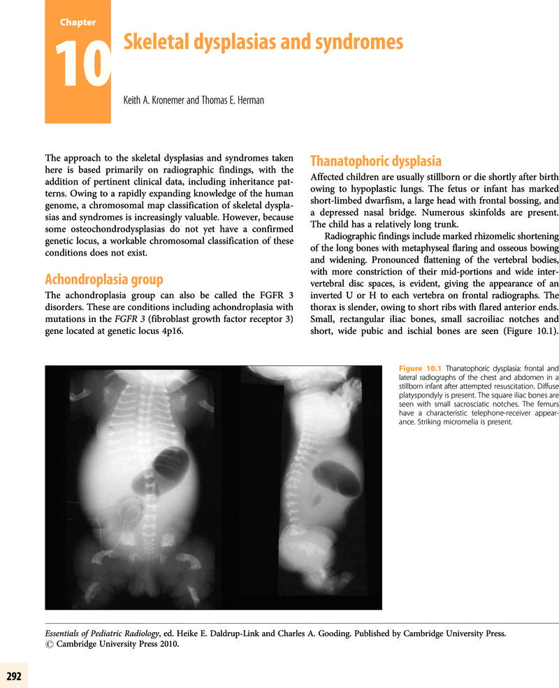 Skeletal Dysplasias And Syndromes (Chapter 10) - Essentials Of ...