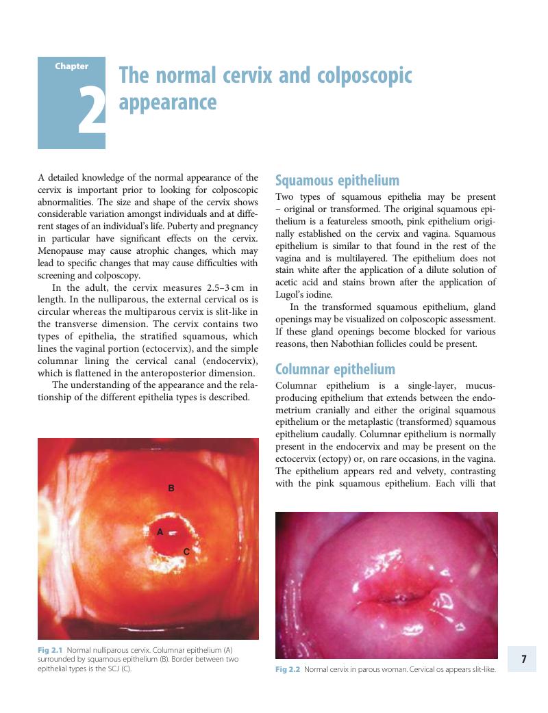 The Normal Cervix And Colposcopic Appearance Chapter 2 Colposcopy