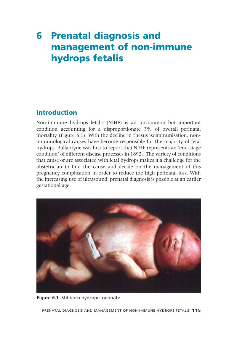 Prenatal Diagnosis And Management Of Non immune Hydrops Fetalis 