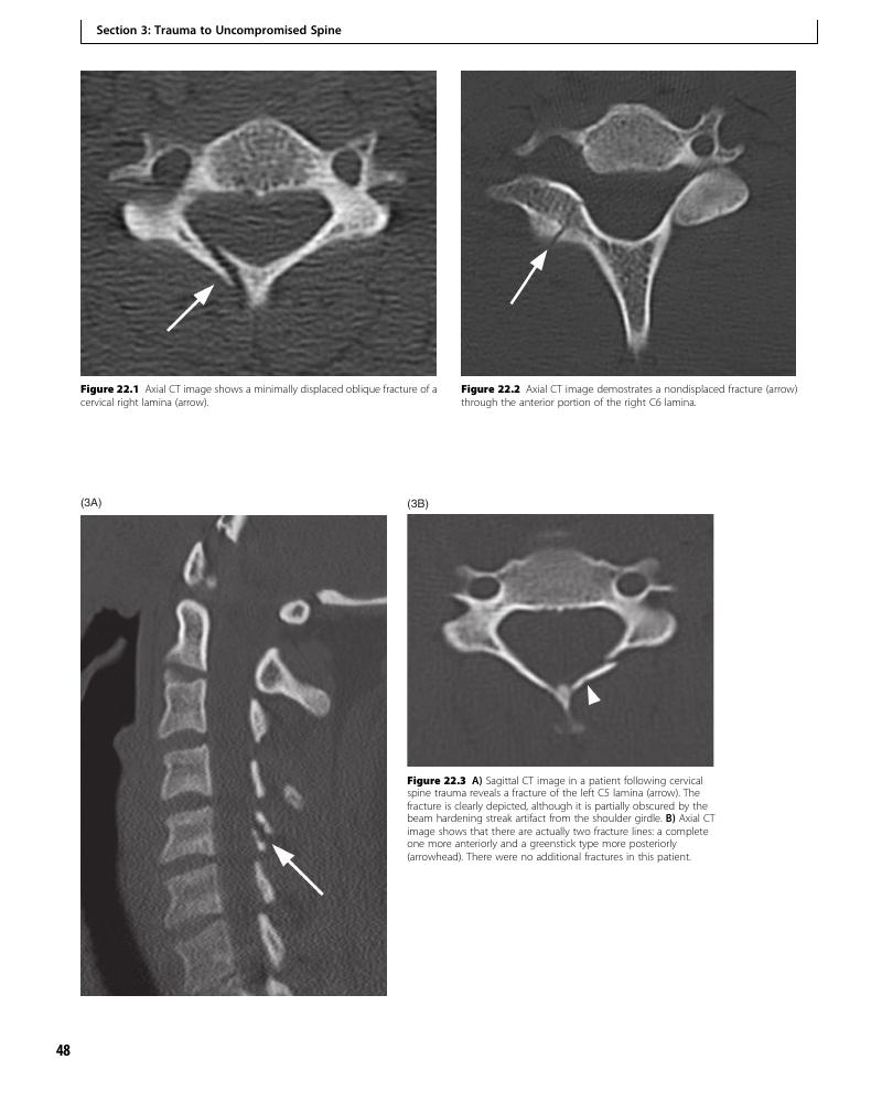 Isolated Fracture Of The Lamina (Case 22) - Clinical Imaging Of Spinal ...