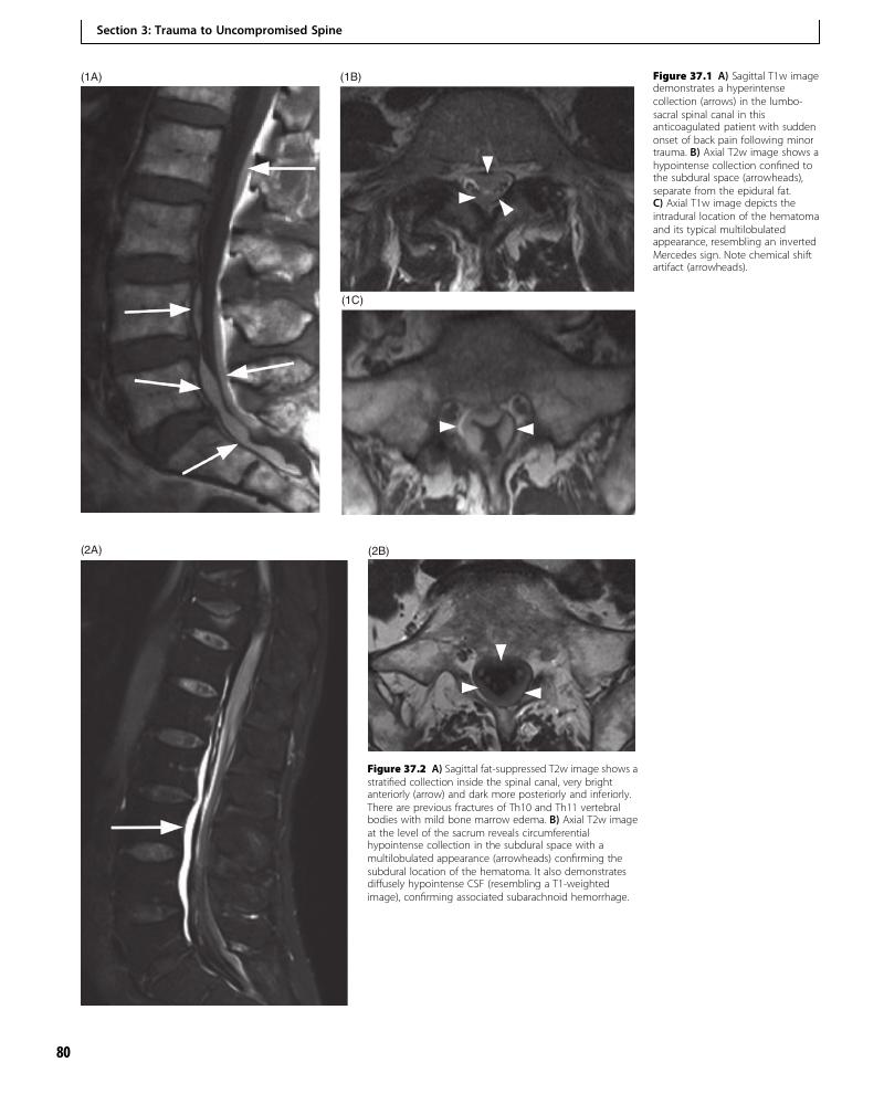 Spinal Subdural Hematoma (Case 37) - Clinical Imaging of Spinal Trauma