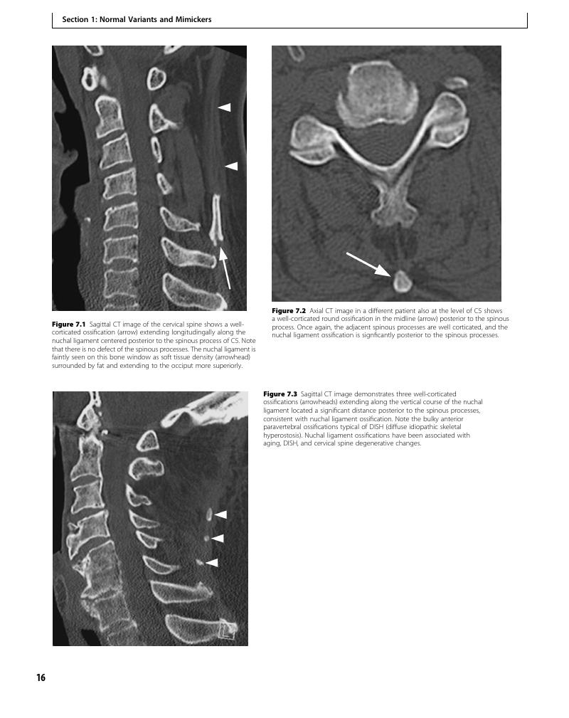 Ossification Of The Nuchal Ligament Case 7 Clinical Imaging Of Spinal Trauma