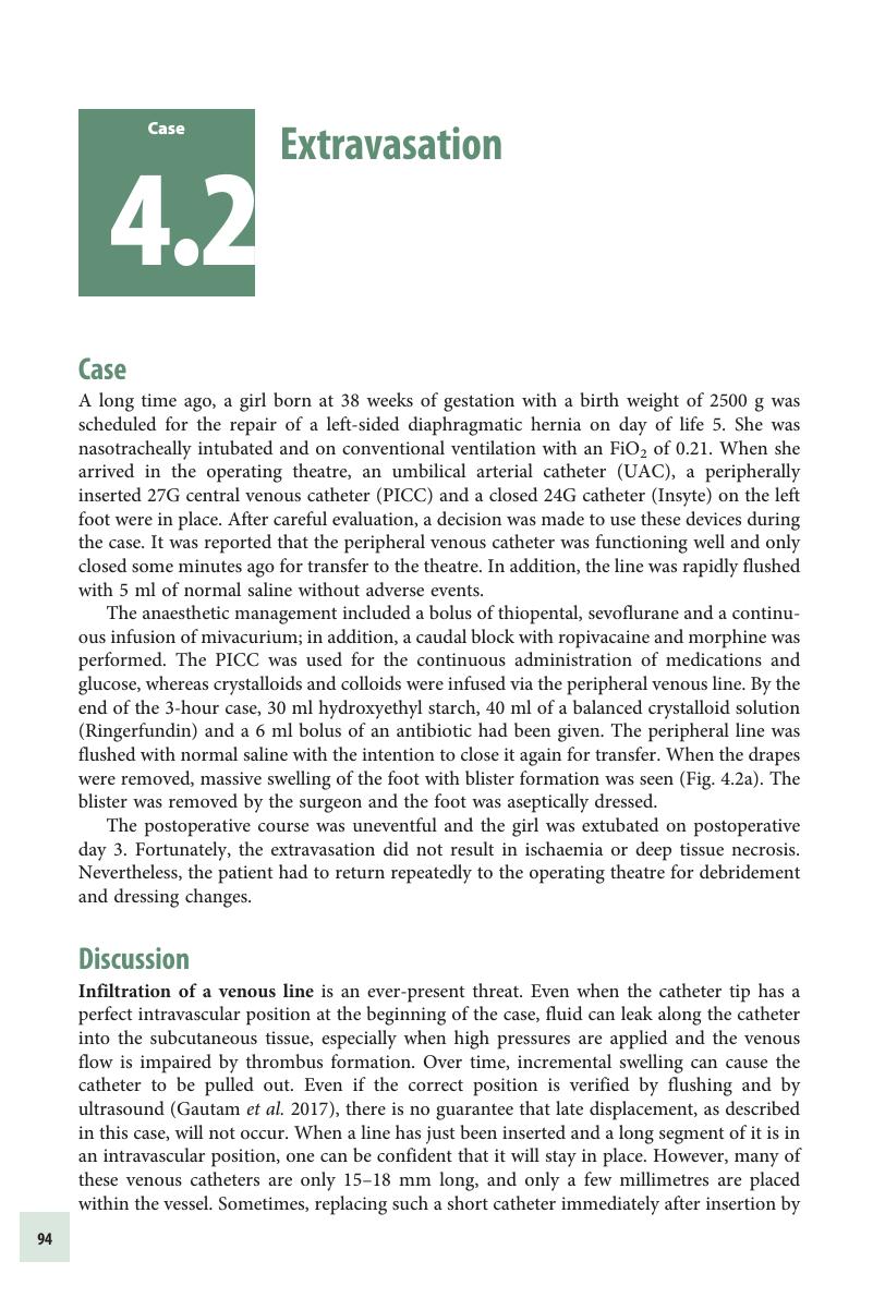 Extravasation (Case 4.2) - Managing Complications In Paediatric Anaesthesia